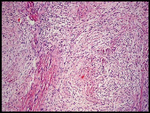 Fibromatosis de tipo desmoide - <div style=